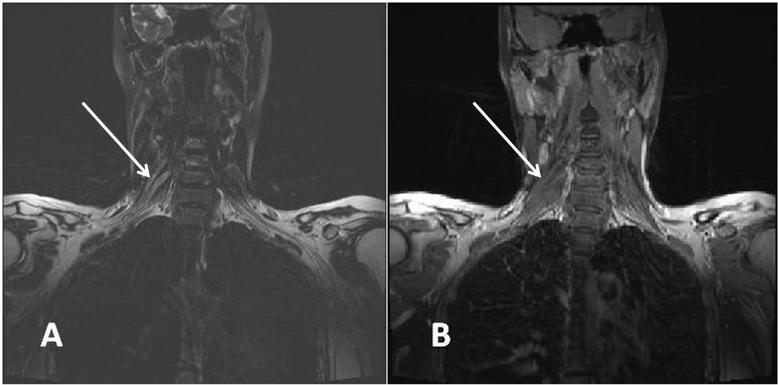 Fig. 3 - T2 FS sequence MRI show focal increased signal intensity lesions of plexus brachialis in patient with MMN (Patient No 7)  (A - without contrast;  B - with contrast)